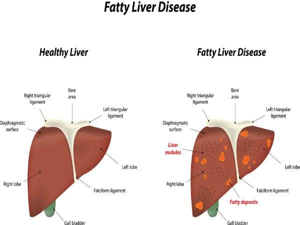 What is a Fatty Liver Disease? How to deal with it? | PHARMA SYNTH ...